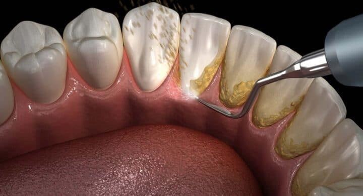 Și tu faci față cu greu tartrului subgingival? Cu Life Dental Spa vei uita de această problema!